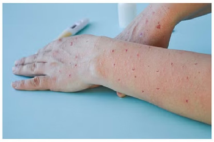 भारत में मंकी पॉक्स वायरस की हुई पुष्टि, स्वास्थ्य मंत्रालय ने किया सतर्क, जानें लक्षण और बचाव...