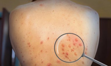 क्या है ऑप्टिकल बायोसेंसर तकनीक जिससे चंद मिनटों में मंकीपॉक्स का लगाया जा सकता है पता, कैसे काम करती है ये तकनीक ?