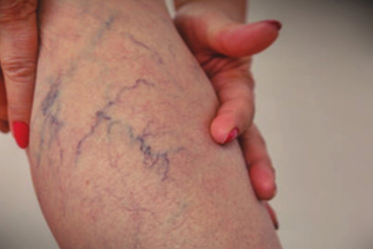 25 प्रतिशत भारतीय वैरिकोज वेन्स से पीड़ित: स्वास्थ्य विशेषज्ञ