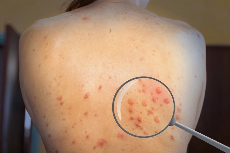 क्या है ऑप्टिकल बायोसेंसर तकनीक जिससे चंद मिनटों में मंकीपॉक्स का लगाया जा सकता है पता, कैसे काम करती है ये तकनीक ?