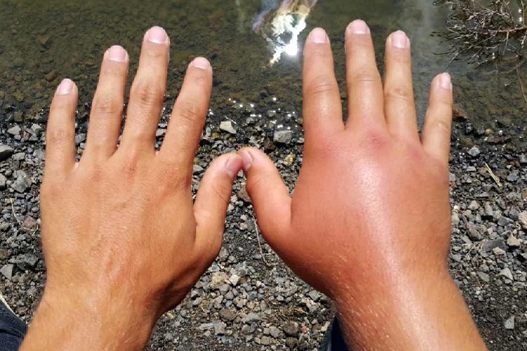 क्या आपके हाथों और उंगलियों में लगातार हो रही है सूजन, तो ना करें इग्नोर इस बीमारी के हैं लक्षण !