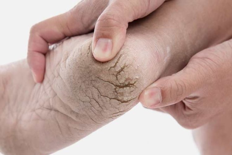 सर्दियों में त्वचा और एड़ियों का फटना, कैसे करें इसका इलाज, किन चीजों से हो सकता है बचाव