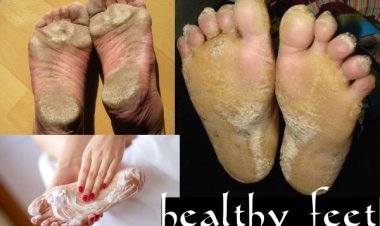 त्वचा देखभाल से अब फटी एड़ियों को कहें Bye Bye