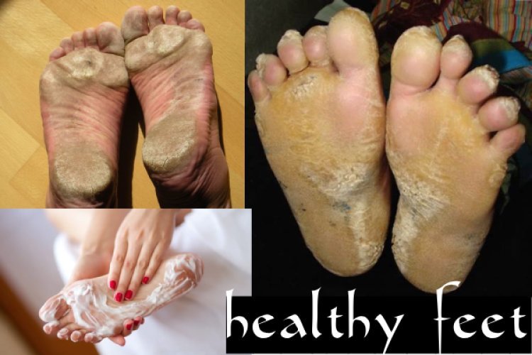 त्वचा देखभाल से अब फटी एड़ियों को कहें Bye Bye