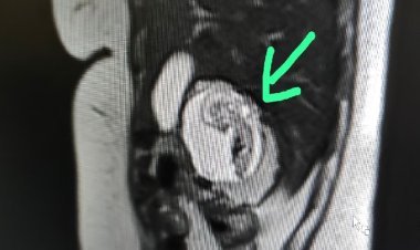 UP में चमत्कार, महिला के गर्भ में नहीं, लिवर में पल रहा बच्चा, विश्व में केवल 18 ऐसे मामले, भारत में पहला