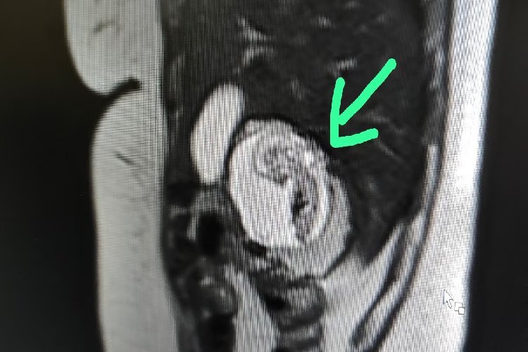 UP में चमत्कार, महिला के गर्भ में नहीं, लिवर में पल रहा बच्चा, विश्व में केवल 18 ऐसे मामले, भारत में पहला