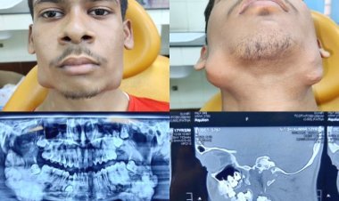 बिहार में अनोखा मेडिकल केस: शख्स की आंख से निकला दांत, डॉक्टर भी हैरान