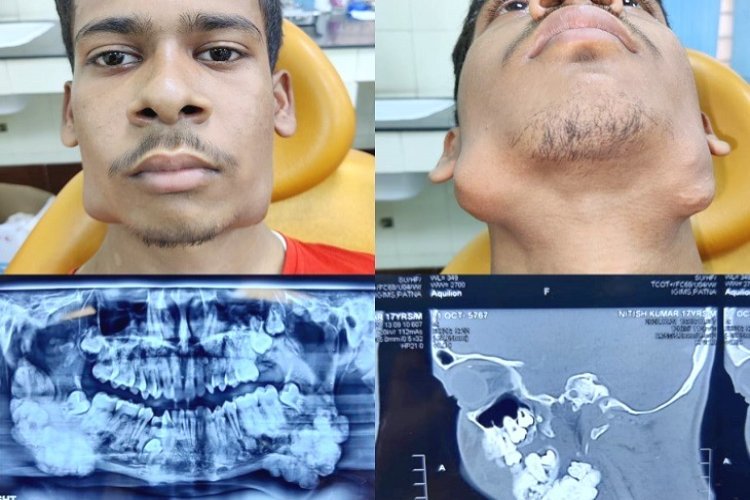 बिहार में अनोखा मेडिकल केस: शख्स की आंख से निकला दांत, डॉक्टर भी हैरान