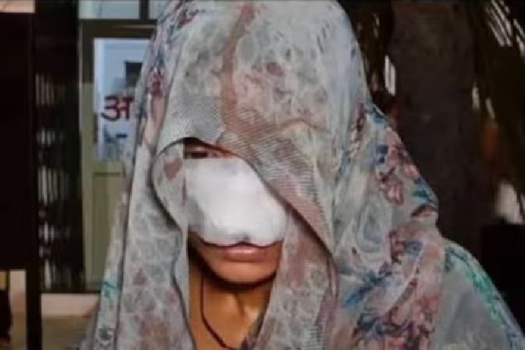 उत्तर प्रदेश के हमीरपुर में पति ने झगड़े के बाद पत्नी की नाक और गाल काट खाए; पत्नी के चेहरे पर लगे 10 टांके